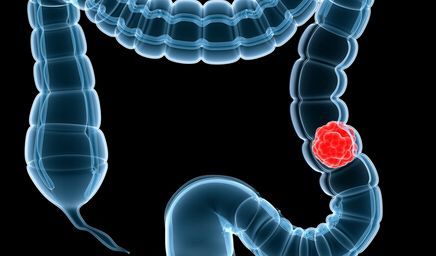 国家癌症中心发布：2022年全国癌症报告！